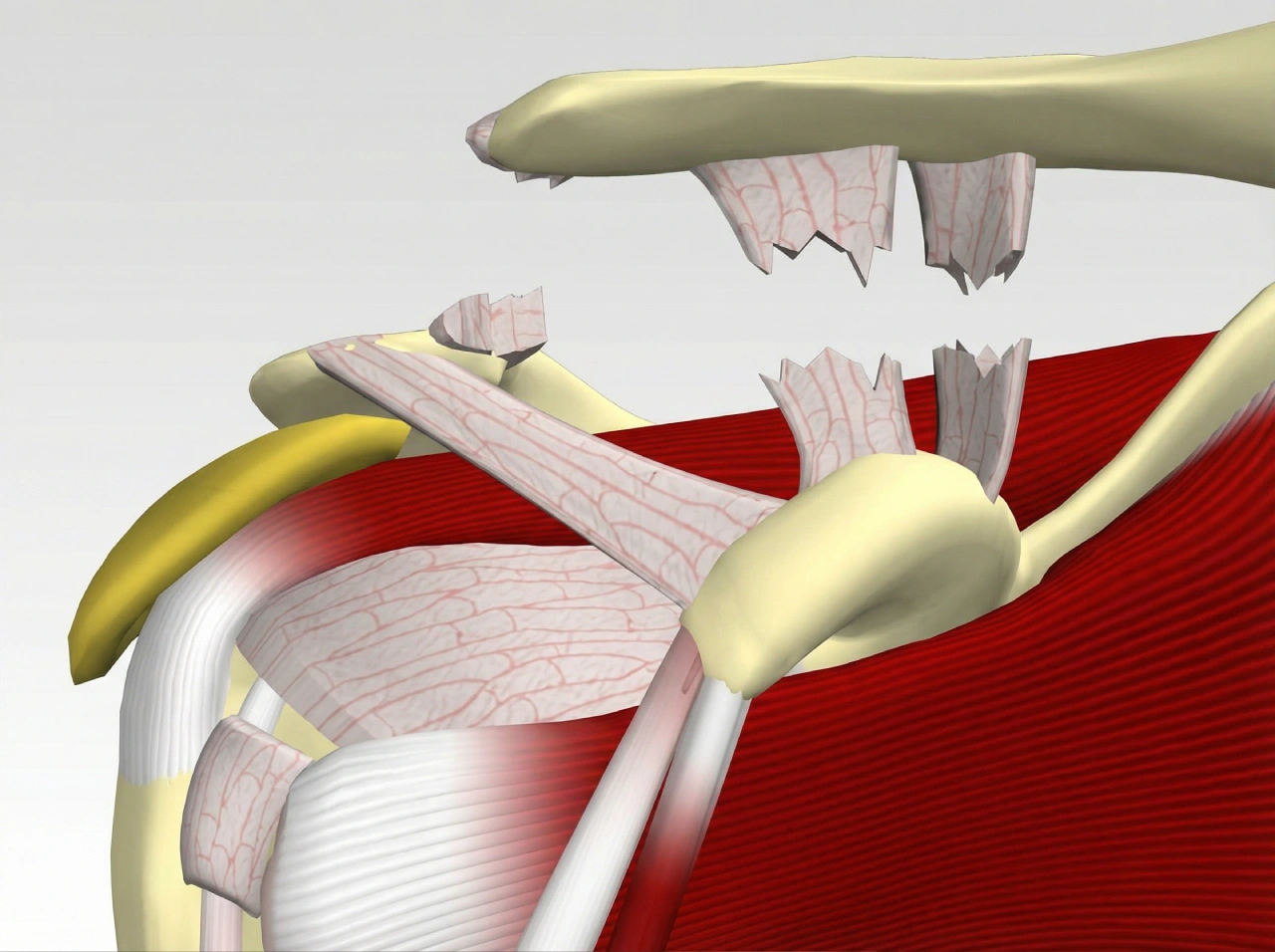 Luxação Acromioclavicular